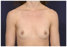 Breast Augmentation Before Photo by Michael Law, MD; Raleigh, NC - Case 32965