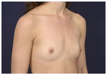 Breast Augmentation Before Photo by Michael Law, MD; Raleigh, NC - Case 32965