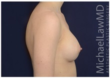 Breast Augmentation After Photo by Michael Law, MD; Raleigh, NC - Case 32965