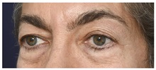 Eyelid Surgery Before Photo by Michael Law, MD; Raleigh, NC - Case 32966