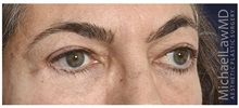 Eyelid Surgery After Photo by Michael Law, MD; Raleigh, NC - Case 32966
