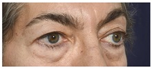 Eyelid Surgery Before Photo by Michael Law, MD; Raleigh, NC - Case 32966
