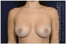 Breast Augmentation After Photo by Michael Law, MD; Raleigh, NC - Case 32968