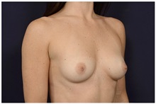 Breast Augmentation Before Photo by Michael Law, MD; Raleigh, NC - Case 32968
