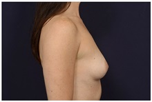 Breast Augmentation Before Photo by Michael Law, MD; Raleigh, NC - Case 32968