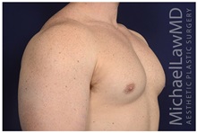 Male Breast Reduction After Photo by Michael Law, MD; Raleigh, NC - Case 32969
