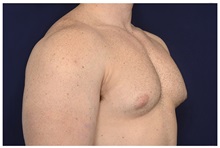 Male Breast Reduction Before Photo by Michael Law, MD; Raleigh, NC - Case 32969