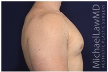 Male Breast Reduction After Photo by Michael Law, MD; Raleigh, NC - Case 32969