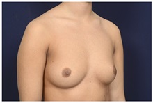 Breast Augmentation Before Photo by Michael Law, MD; Raleigh, NC - Case 32971