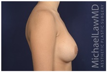 Breast Augmentation After Photo by Michael Law, MD; Raleigh, NC - Case 32971