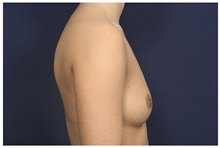 Breast Augmentation Before Photo by Michael Law, MD; Raleigh, NC - Case 32971