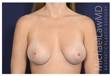 Breast Augmentation After Photo by Michael Law, MD; Raleigh, NC - Case 32972