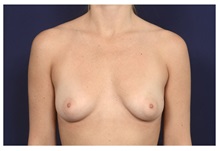 Breast Augmentation Before Photo by Michael Law, MD; Raleigh, NC - Case 32972
