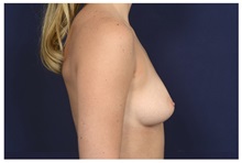 Breast Augmentation Before Photo by Michael Law, MD; Raleigh, NC - Case 32972