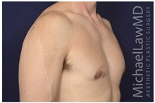 Male Breast Reduction After Photo by Michael Law, MD; Raleigh, NC - Case 32973