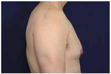 Male Breast Reduction Before Photo by Michael Law, MD; Raleigh, NC - Case 32973