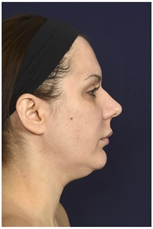 Liposuction Before Photo by Michael Law, MD; Raleigh, NC - Case 32975
