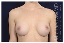 Breast Augmentation After Photo by Michael Law, MD; Raleigh, NC - Case 32976