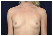 Breast Augmentation Before Photo by Michael Law, MD; Raleigh, NC - Case 32976