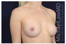 Breast Augmentation After Photo by Michael Law, MD; Raleigh, NC - Case 32976