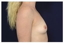 Breast Augmentation Before Photo by Michael Law, MD; Raleigh, NC - Case 32976