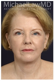 Facelift After Photo by Michael Law, MD; Raleigh, NC - Case 32979