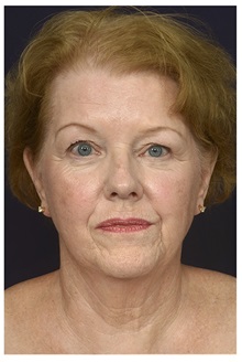 Facelift Before Photo by Michael Law, MD; Raleigh, NC - Case 32979
