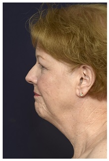 Facelift Before Photo by Michael Law, MD; Raleigh, NC - Case 32979