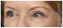 Eyelid Surgery After Photo by Michael Law, MD; Raleigh, NC - Case 32980