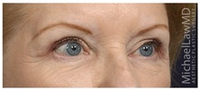 Eyelid Surgery After Photo by Michael Law, MD; Raleigh, NC - Case 32980