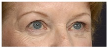 Eyelid Surgery Before Photo by Michael Law, MD; Raleigh, NC - Case 32980