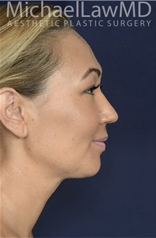 Liposuction After Photo by Michael Law, MD; Raleigh, NC - Case 32981