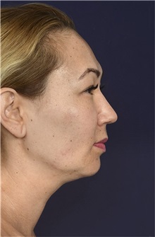 Liposuction Before Photo by Michael Law, MD; Raleigh, NC - Case 32981