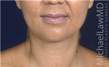 Liposuction After Photo by Michael Law, MD; Raleigh, NC - Case 32982