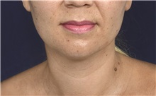 Liposuction Before Photo by Michael Law, MD; Raleigh, NC - Case 32982