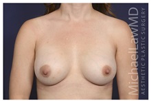 Breast Augmentation After Photo by Michael Law, MD; Raleigh, NC - Case 32983