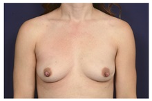Breast Augmentation Before Photo by Michael Law, MD; Raleigh, NC - Case 32983