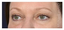 Eyelid Surgery After Photo by Michael Law, MD; Raleigh, NC - Case 32984