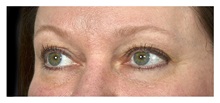 Eyelid Surgery Before Photo by Michael Law, MD; Raleigh, NC - Case 32984