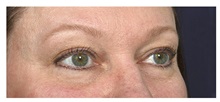 Eyelid Surgery Before Photo by Michael Law, MD; Raleigh, NC - Case 32984