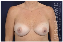 Breast Augmentation After Photo by Michael Law, MD; Raleigh, NC - Case 32985