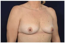 Breast Augmentation Before Photo by Michael Law, MD; Raleigh, NC - Case 32985
