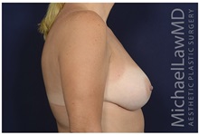 Breast Augmentation After Photo by Michael Law, MD; Raleigh, NC - Case 32985