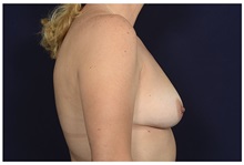 Breast Augmentation Before Photo by Michael Law, MD; Raleigh, NC - Case 32985