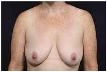 Breast Lift Before Photo by Michael Law, MD; Raleigh, NC - Case 32987