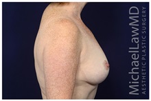 Breast Lift After Photo by Michael Law, MD; Raleigh, NC - Case 32987