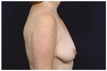 Breast Lift Before Photo by Michael Law, MD; Raleigh, NC - Case 32987