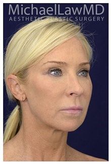 Facelift After Photo by Michael Law, MD; Raleigh, NC - Case 32988