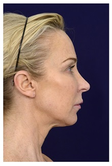 Facelift Before Photo by Michael Law, MD; Raleigh, NC - Case 32988