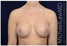 Breast Augmentation After Photo by Michael Law, MD; Raleigh, NC - Case 32989